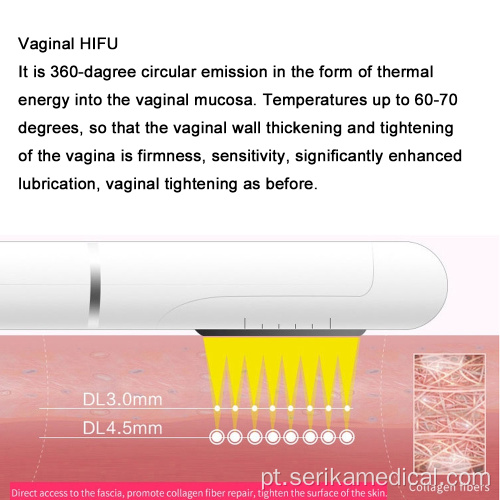 Aperto vaginal 4D portátil HIFU Mahcine